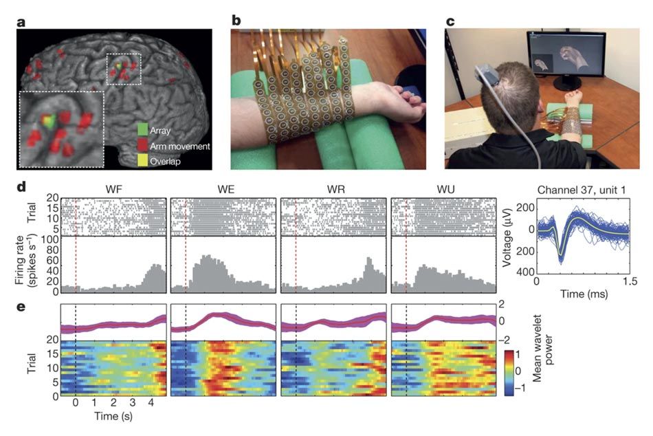 This image is from the 2016 NeuroLife study. In the upper left is an image of the brain that shows the location of the implanted microgrid array. Upper middle shows Burkhart’s forearm wrapped in a sleeve of electrodes. Upper right shows Burkhart seated facing a computer monitor. On the monitor is an avatar if his right hand. He is wearing the electrode sleeve. The bottom of the picture shows a series grayscale histograms and multicolor raster readings that correspond to neuron activity when wrist movements were attempted.