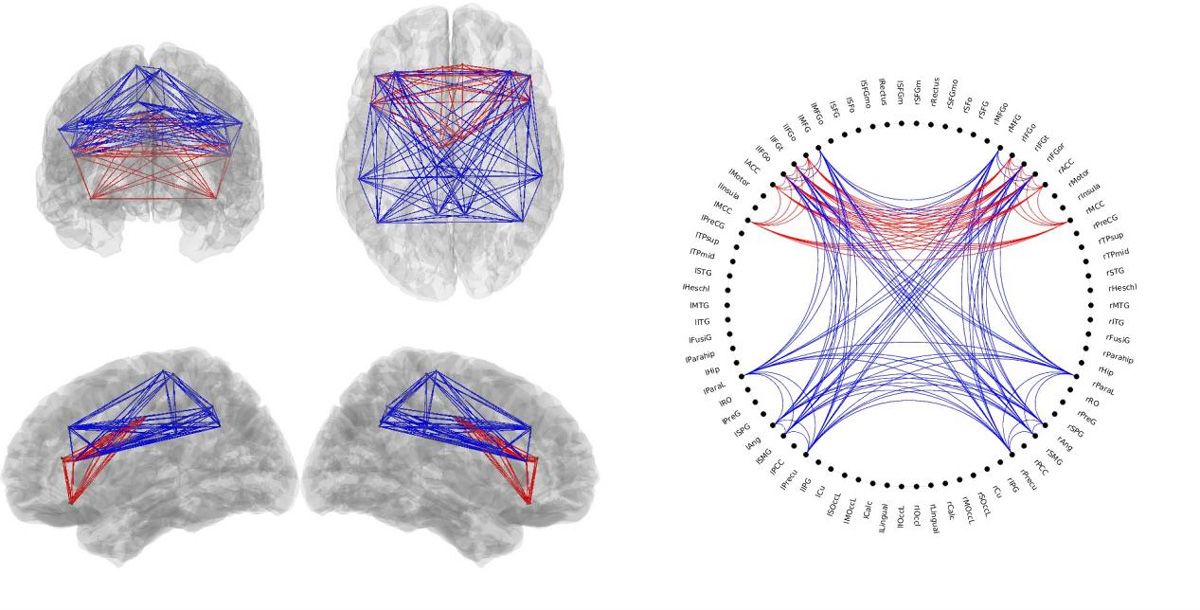 四张大脑图像，上面叠加着红线和蓝线，显示的是具有高连通性和低连通性的区域。