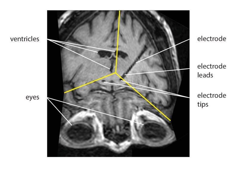 患者大脑的 MRI 图像，显示电极相对于眼睛和脑室的位置。