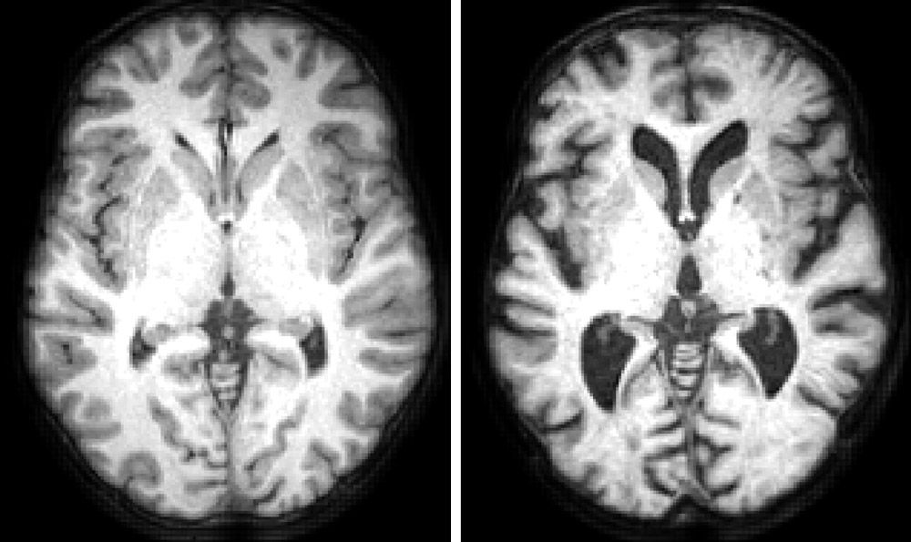 图 1. 结构性 MRI 图像显示了典型的 19 岁健康人大脑（左）和典型的 86 岁健康人大脑（右）的横切面。随着年龄的增长，灰质（大脑边缘的卷积）和白质（剩余的较轻物质）逐渐缩小，导致老年人大脑中的黑洞（脑室）变大。