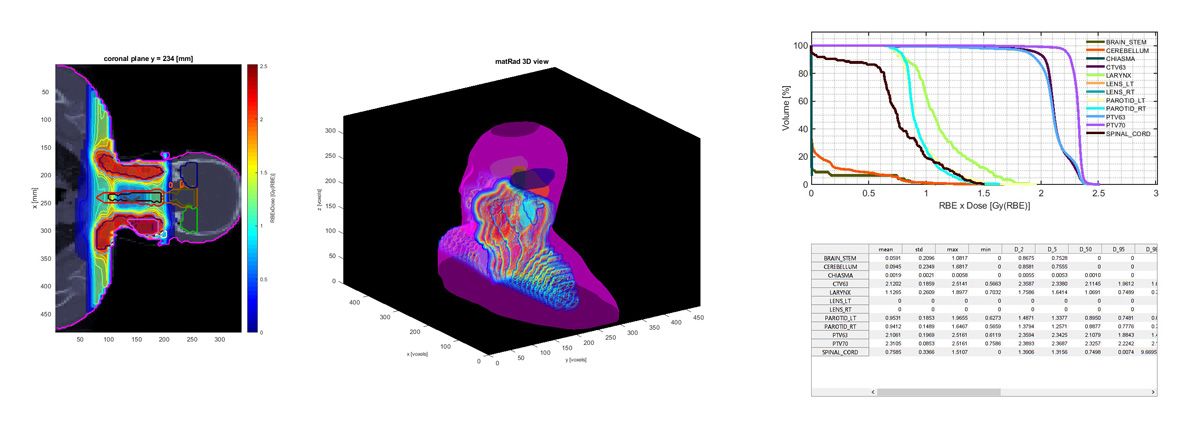 图 4.matRad 中生成的可视化结果。左侧：头颈癌病例冠状面的 CT 图像及其中的计划质子剂量。中间：同一可视化结果的三维渲染。右侧：采样剂量直方图和统计表。