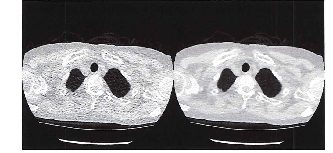 图 1.超低剂量 CT（左侧）与传统 CT（右侧）的图像质量比较。