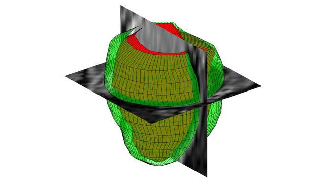 Three dimensional geometrical reconstruction of the human left ventricle from MR images. 