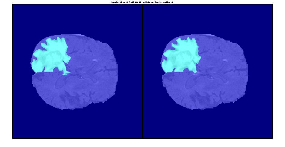 显示使用医学图像处理分割的肿瘤组织的脑部 MRI。
