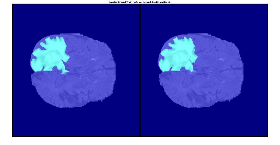 使用 MATLAB 在脑组织中分割的肿瘤图，左图采用标注的真实值，右图采用网络预测。