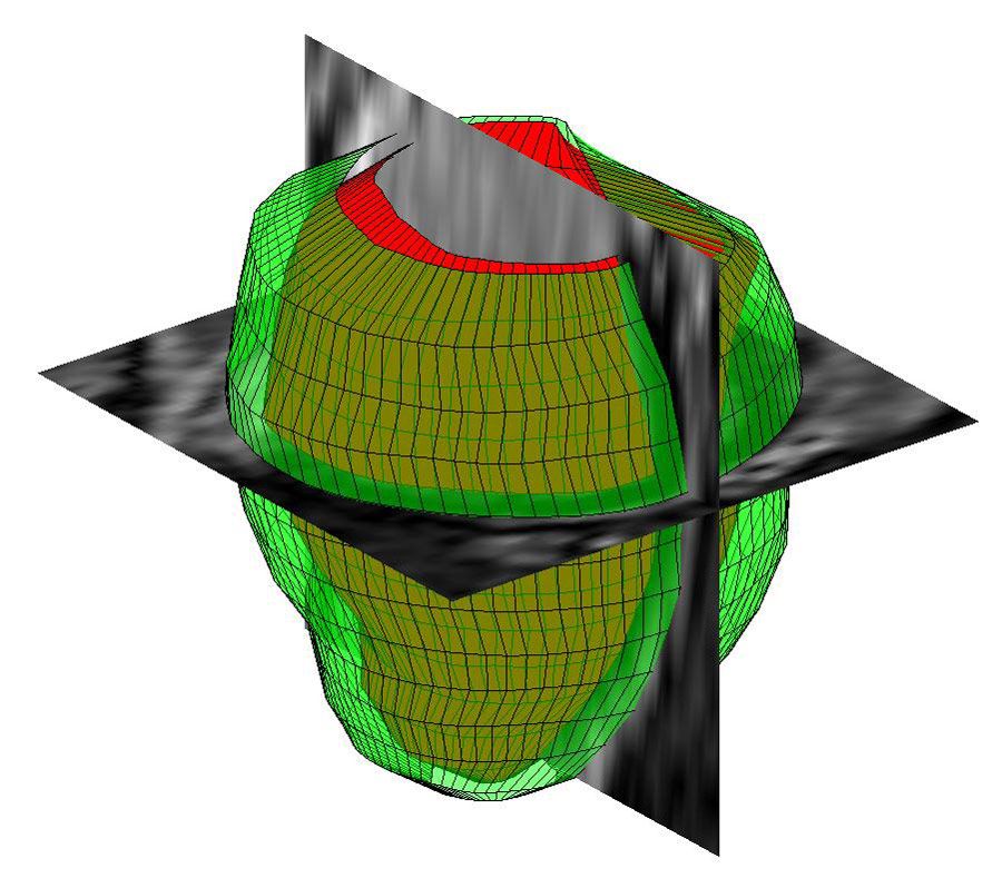 借助 MATLAB，使用 MR 图像对人体左心室进行三维几何重建。