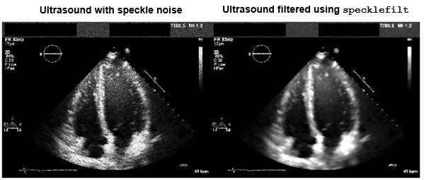 并排比较：原始超声图像和滤除散斑噪声的超声图像。