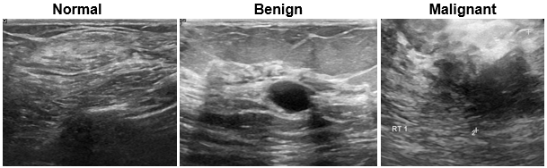 Ultrasound images of normal breast tissue, a benign tumor, and a malignant tumor