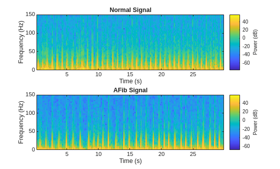 Classify ECG Signals Using Long Short-Term Memory Networks with GPU Acceleration