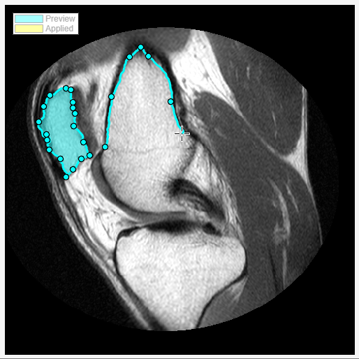 Waypoints are shown outlining a segmented portion of the knee scan.