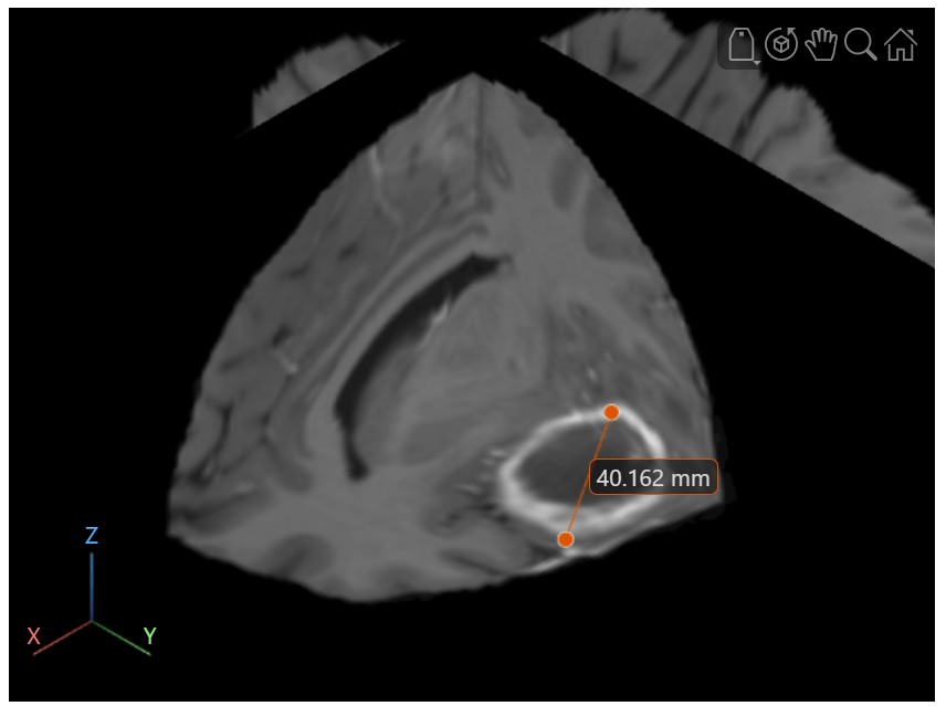 3-D display of the brain MRI volume with a red line annotation across the diameter of the tumor, labeled 40.162 mm