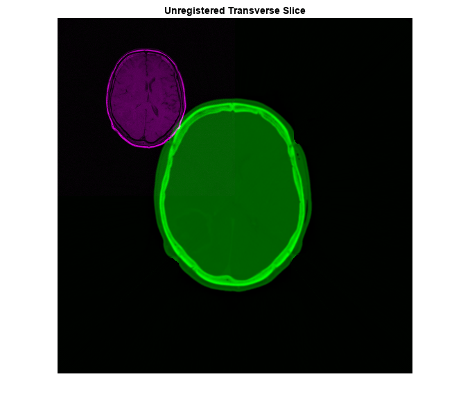 Figure contains an axes object. The axes object with title Unregistered Transverse Slice contains an object of type image.