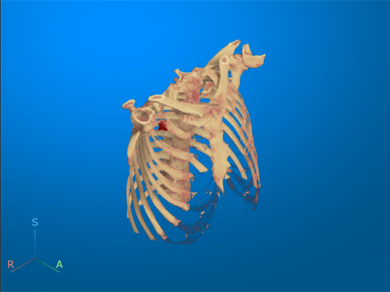 Chest CT display after bed removal